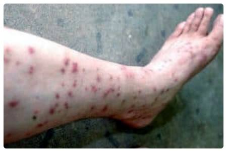 Punture di Pappataci